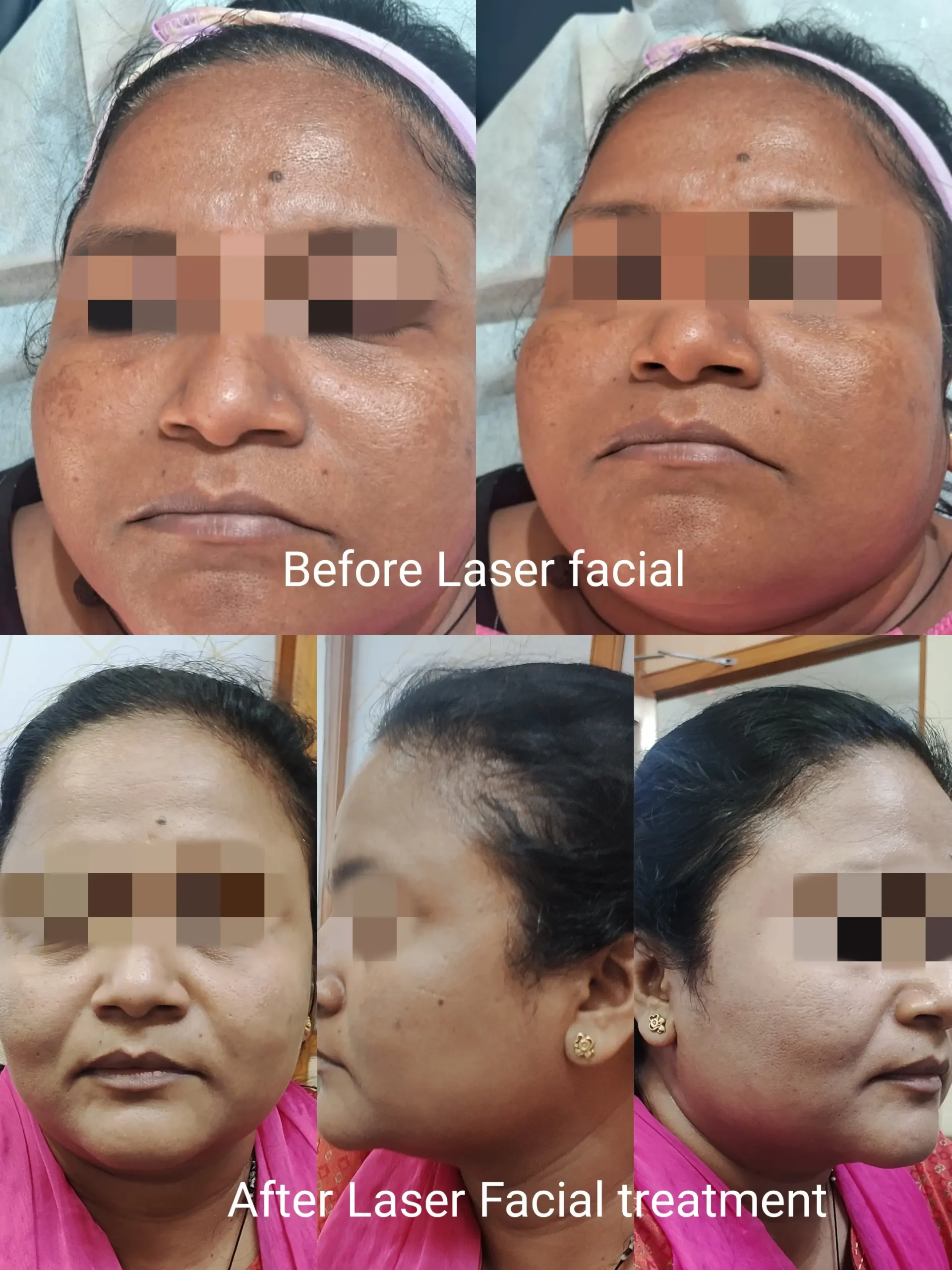 Laser Hair Removal