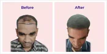 hairimg
