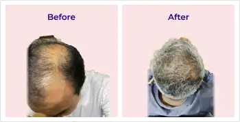 hairimg