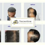 hair transplant
