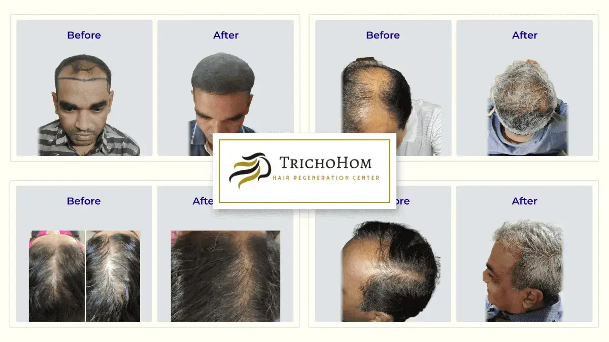 hair transplant