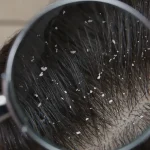 leading causes dandruff