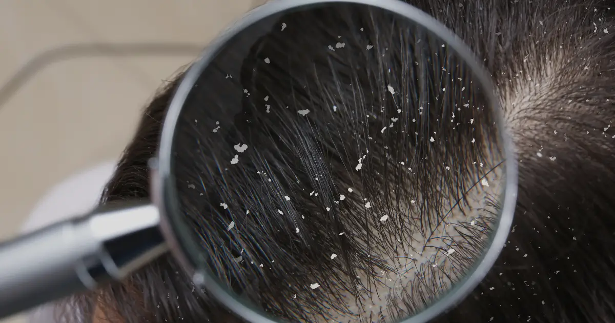 leading causes dandruff