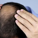 Hair Loss Due to Nutritional Deficiency