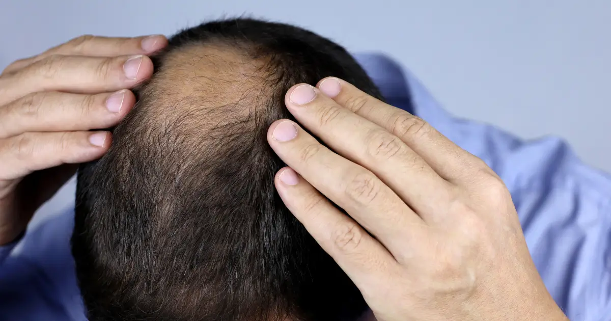 Hair Loss Due to Nutritional Deficiency
