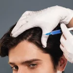 Can PRP treatment stop hair loss