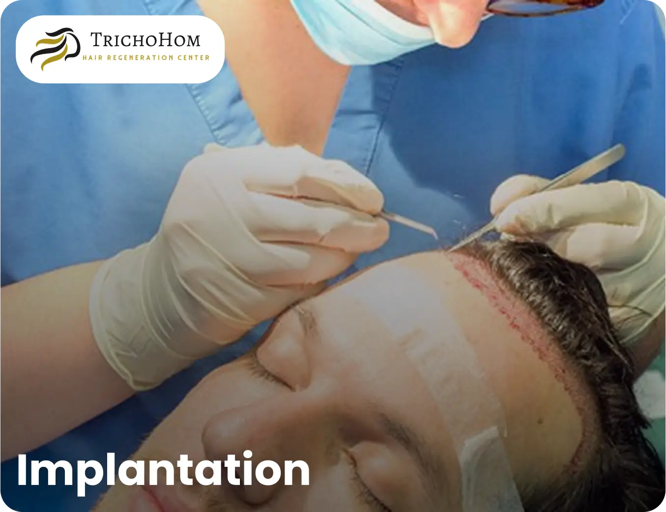 implantation