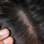 Six Dermatologically advised ways to get rid of dandruff