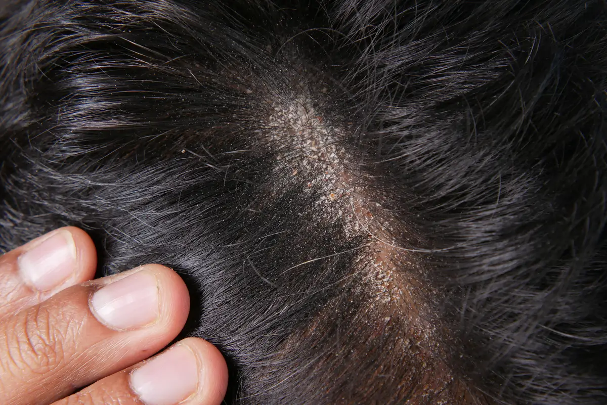 Six Dermatologically advised ways to get rid of dandruff