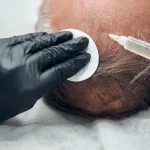 Can PRP therapy reverse hair loss