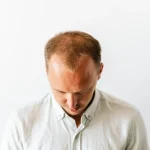 6 Reasons for Sudden Hair Loss