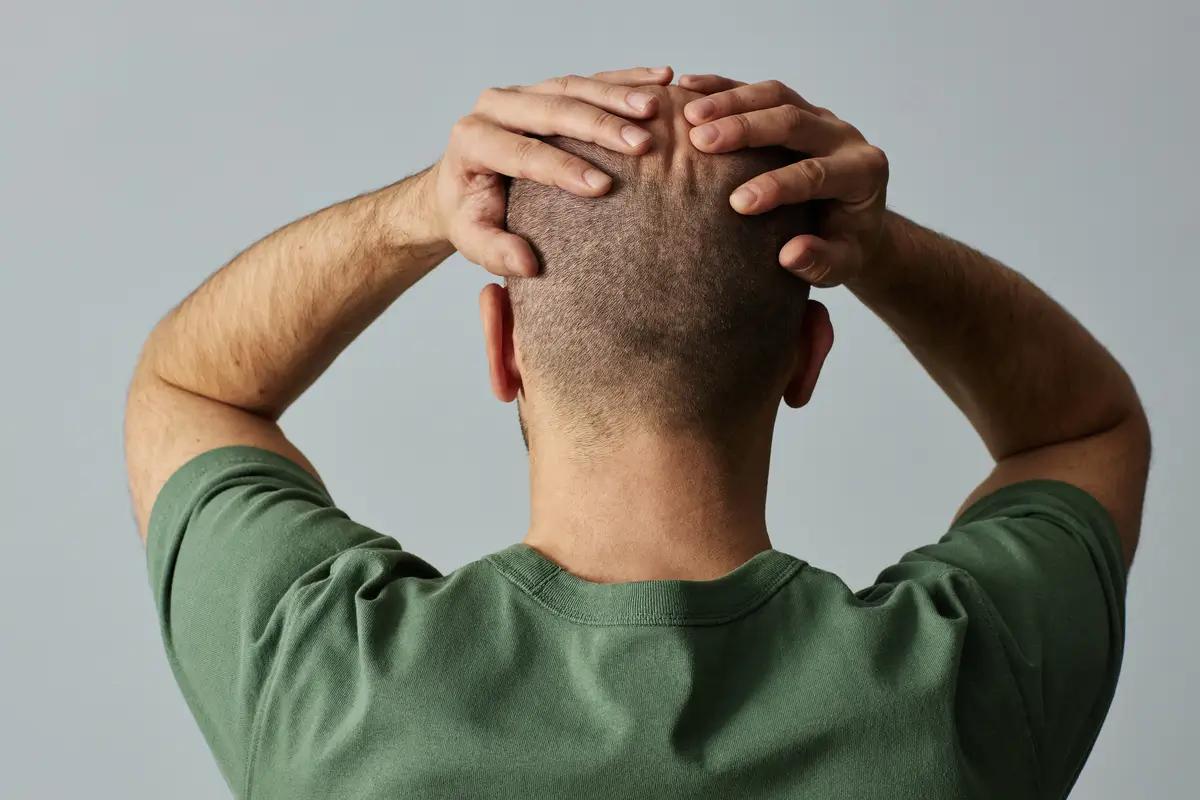 Can Covid-19 cause Hair Loss