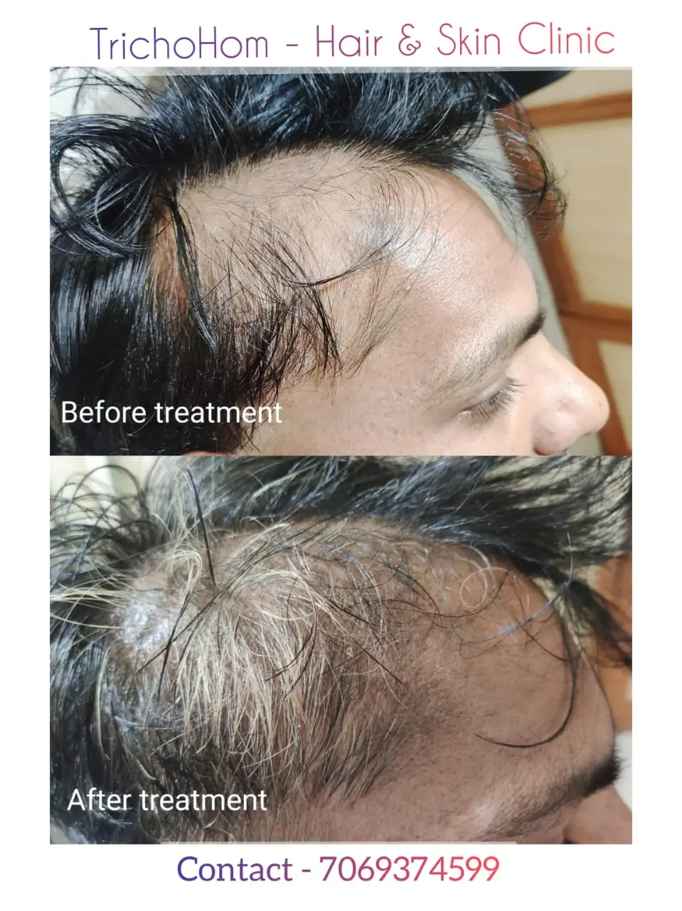glutathione alopecia areata Alopecia Areata Hair Loss Treatment | TrichoHom