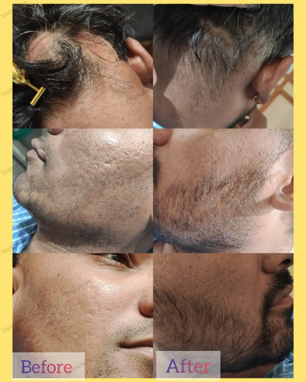 glutathione alopecia areata Alopecia Areata Hair Loss Treatment | TrichoHom