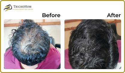 Hair Treatment
