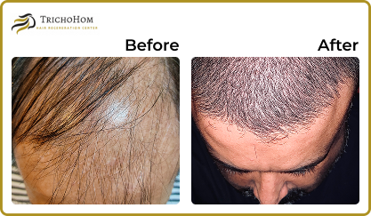 Hair Treatment