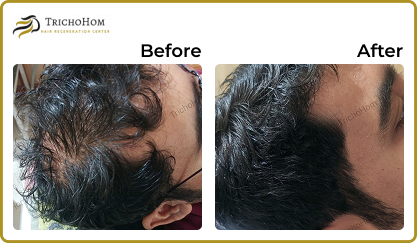Hair Treatment
