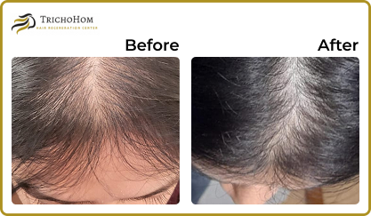 Hair Treatment
