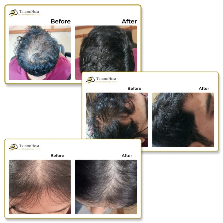 Before-After