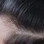 dandruff