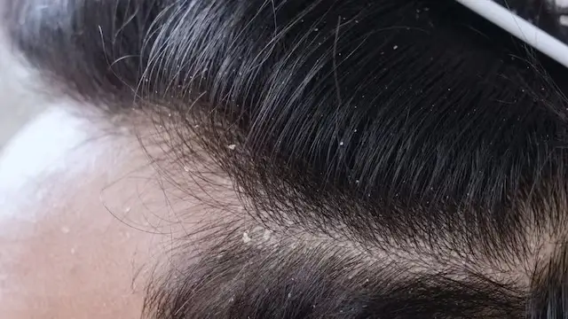 dandruff