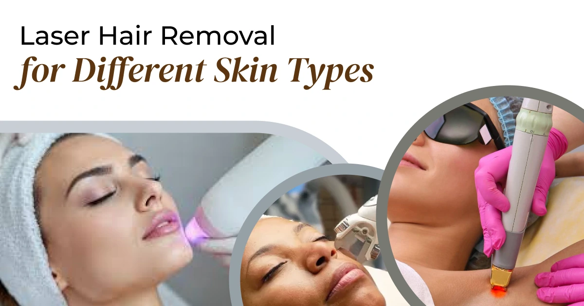 Laser Hair Removal for All Skin Types: Safe & Effective