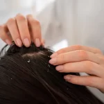 Scalp Conditions
